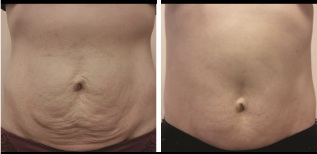 EMSlim/Endermologie New You Body Contour Center